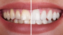 Close-up Of A Smiling Woman's Teeth Before And After Whitening Close-up Of A Smiling Woman's Teeth Before And After Whitening