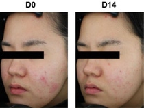 アクネ肌とオイリー肌をクリアな肌へ