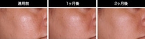 連用前 / 1ヶ月後 / 2ヶ月後